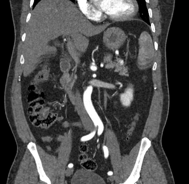 Celiac artery dissection (Radiopaedia 52194-58080 C 50).jpg