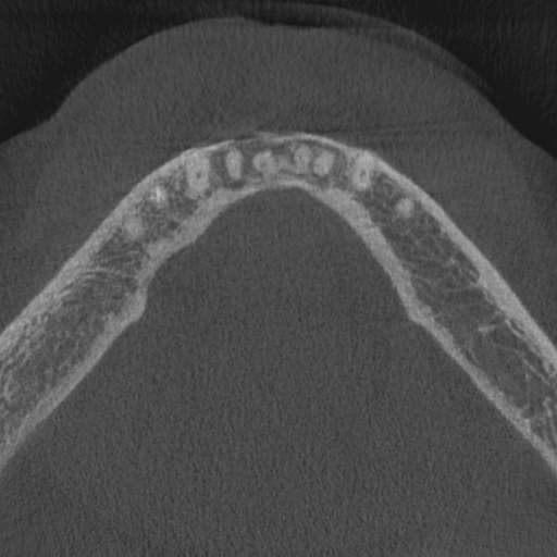 Cemento-osseous dysplasia (Radiopaedia 48251-53126 Axial non-contrast 21).jpg