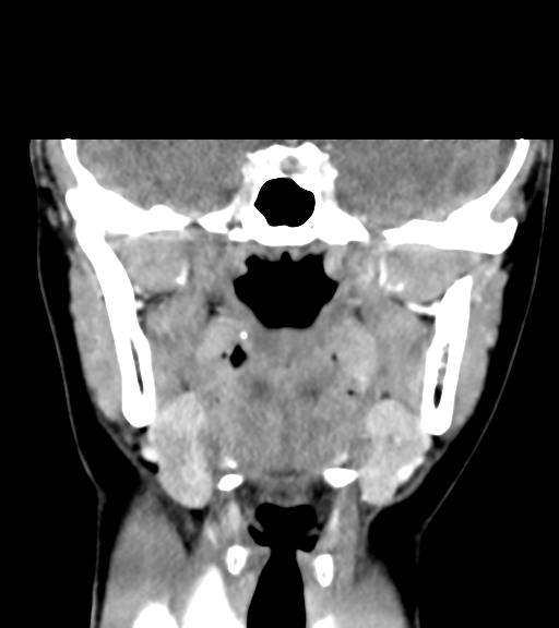 Cemento-ossifying fibroma (Radiopaedia 46243-50643 Coronal C+ delayed 34).png