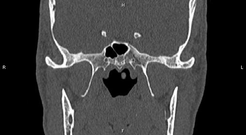 Central giant cell granuloma (Radiopaedia 83346-97761 Coronal bone window 24).jpg