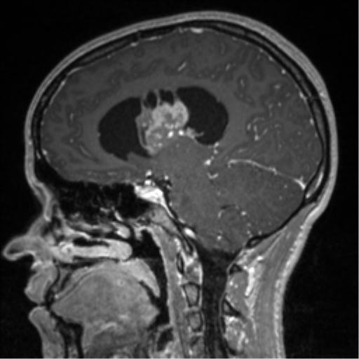 File:Central neurocytoma (Radiopaedia 37664-39557 Sagittal T1 C+ 44).png