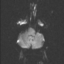 Central neurocytoma (Radiopaedia 56690-63469 Axial DWI 40).jpg