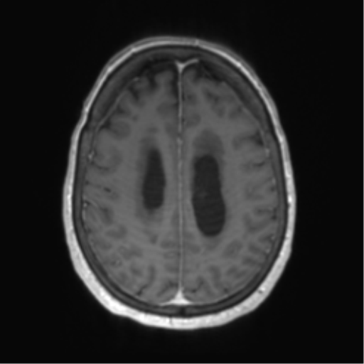 Central neurocytoma (Radiopaedia 65317-74345 Axial T1 C+ 42).png
