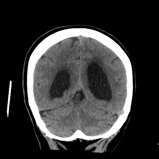 Central neurocytoma (Radiopaedia 65317-74346 Coronal non-contrast 44).png