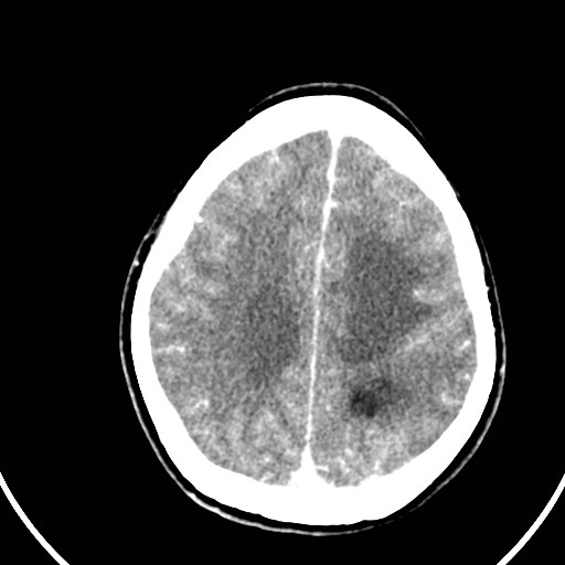 Central neurocytoma (Radiopaedia 84497-99871 B 37).jpg