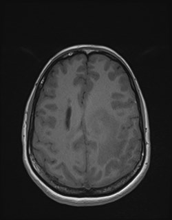 Central neurocytoma (Radiopaedia 84497-99872 Axial T1 140).jpg