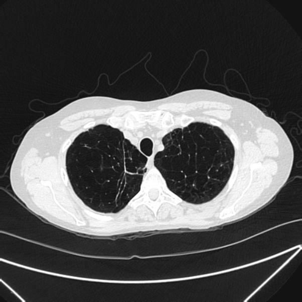 Centrilobular pulmonary emphysema (Radiopaedia 24495-24789 Axial lung window 15).jpg