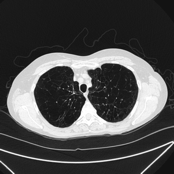 Centrilobular pulmonary emphysema (Radiopaedia 24495-24789 Axial lung window 21).jpg