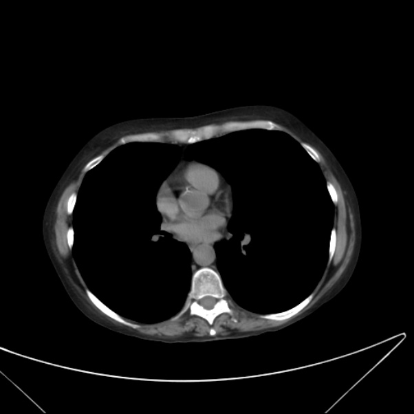 Centrilobular pulmonary emphysema (Radiopaedia 24495-24789 Axial non-contrast 28).jpg