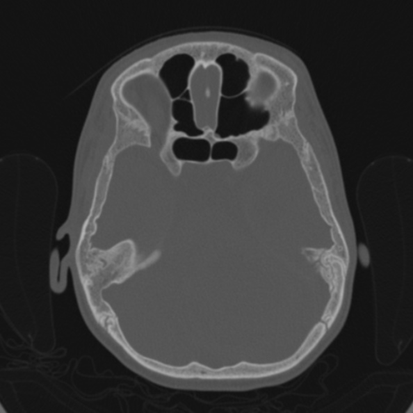 File:Cerebellar abscess secondary to mastoiditis (Radiopaedia 26284-26413 Axial bone window 74).jpg