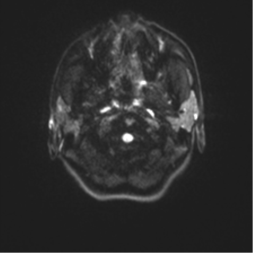 Cerebellar agenesis with hypoplastic pons (pontocerebellar hypoplasia) (Radiopaedia 57224-64138 Axial DWI 39).png
