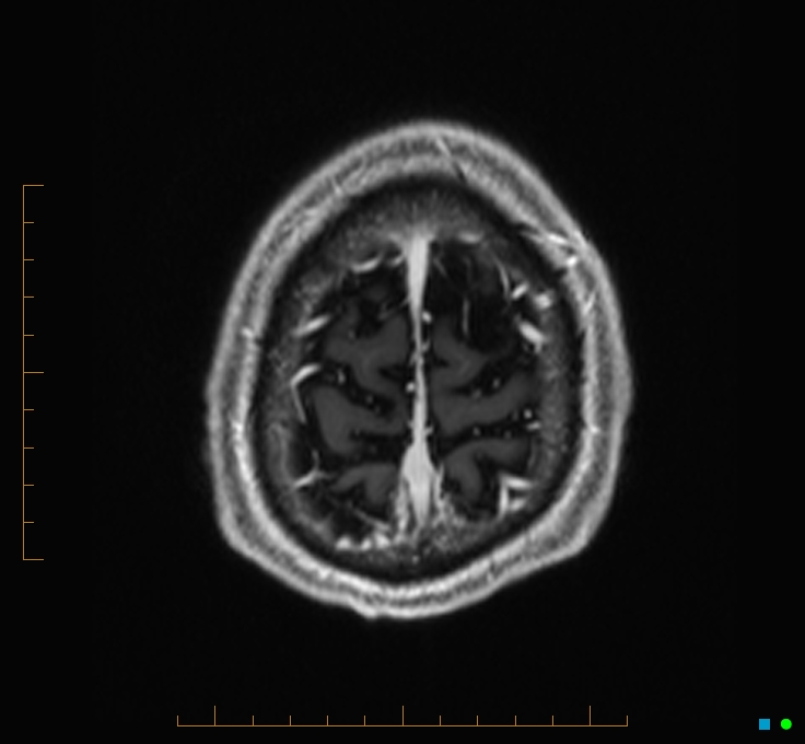 Cerebellar gangliocytoma (Radiopaedia 65377-74422 Axial T1 C+ 133).jpg