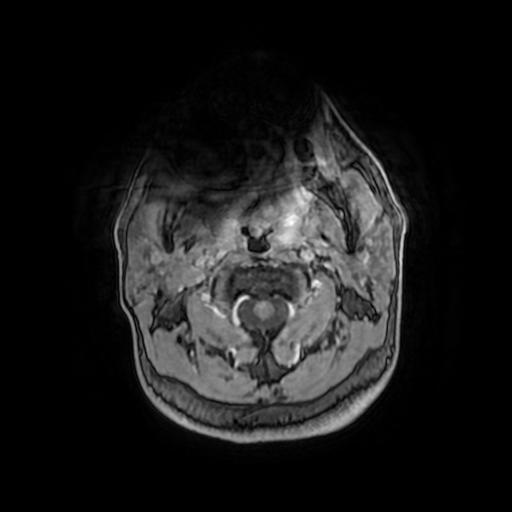 Cerebellar hemangioblastoma (Radiopaedia 88055-104622 Axial T1 C+ 1).jpg