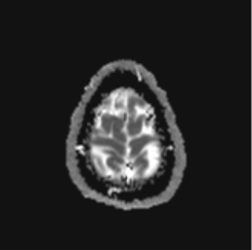 File:Cerebellar hemangioblastomas and pituitary adenoma (Radiopaedia 85490-101176 Axial ADC 32).png