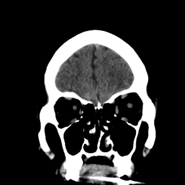 Cerebellar hemorrhage causing obstructive hydrocephalus (Radiopaedia 33989-35207 Coronal non-contrast 13).jpg