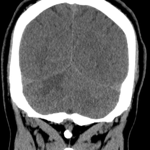 Cerebellar infarction (Radiopaedia 16625-16327 Coronal non-contrast 32).jpg