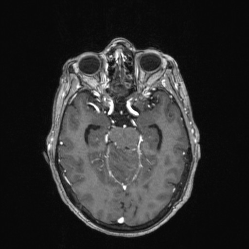 Cerebellar metastases (Radiopaedia 24038-24249 Axial T1 C+ 23).jpg