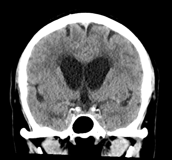 File:Cerebellar metastasis from lung adenocarcinoma (Radiopaedia 86690-102828 Coronal non-contrast 17).png