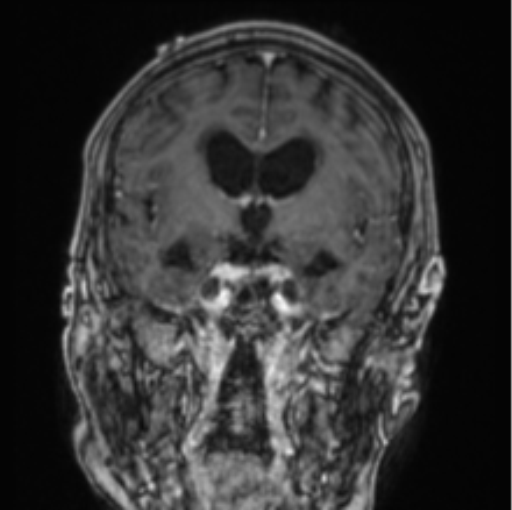 File:Cerebellar metastasis from lung adenocarcinoma (Radiopaedia 86690-102829 Coronal T1 C+ 57).png