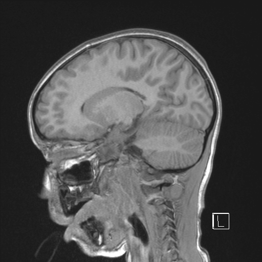 Cerebellar stroke (Radiopaedia 32202-33150 Sagittal T1 C+ 32).png