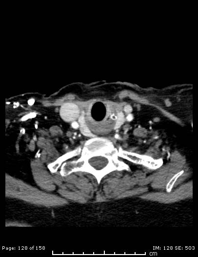 File:Cerebellar strokes due to intracranial giant cell arteritis (Radiopaedia 68799-78510 CT angiogram 128).jpg