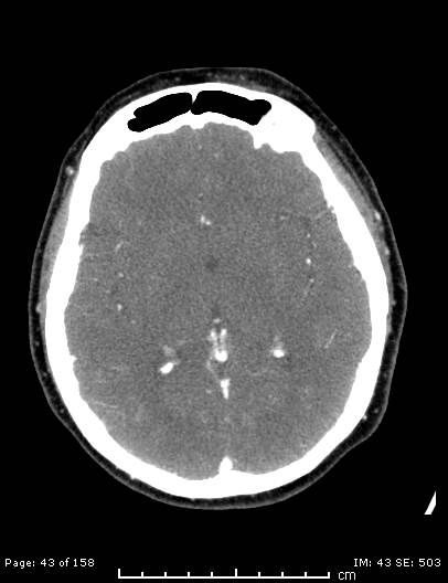 Cerebellar strokes due to intracranial giant cell arteritis (Radiopaedia 68799-78510 CT angiogram 43).jpg