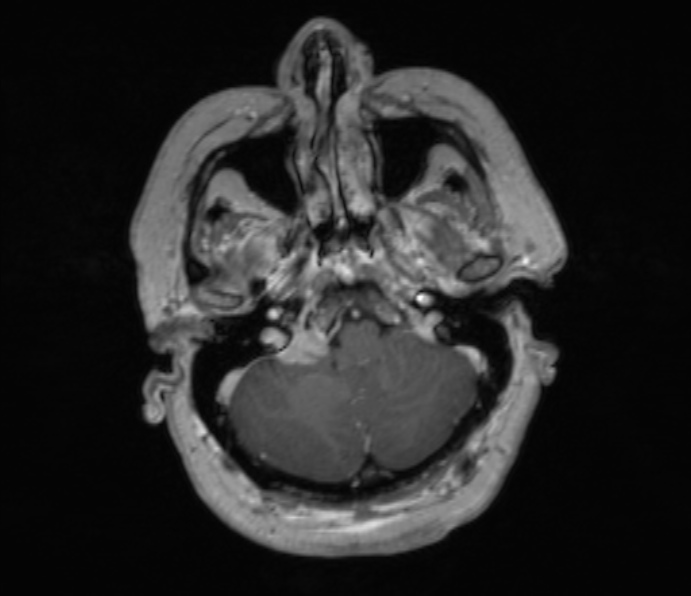 Cerebellopontine angle meningioma (Radiopaedia 35181-36715 Axial T1 C+ 45).jpg