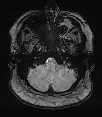 Cerebellopontine angle meningioma (Radiopaedia 48434-53348 Axial SWI 15).png