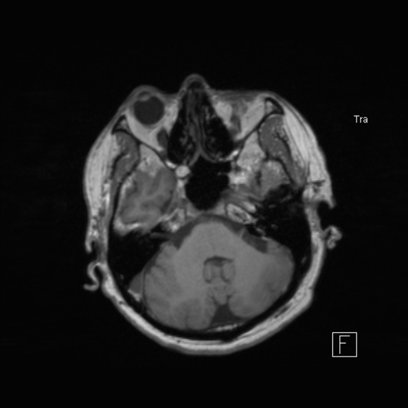 Cerebral abscess (Radiopaedia 26111-26247 Axial T1 21).jpg