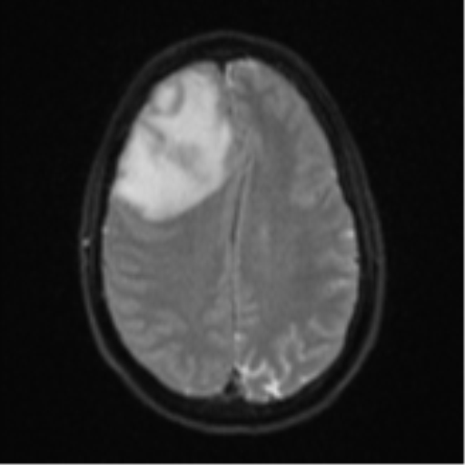 Cerebral abscess (Radiopaedia 60342-68009 Axial DWI 25).png