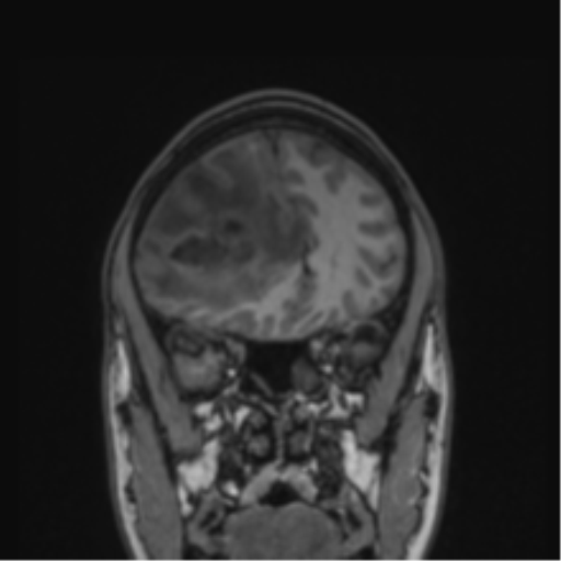 Cerebral abscess (Radiopaedia 60342-68009 Coronal T1 39).png