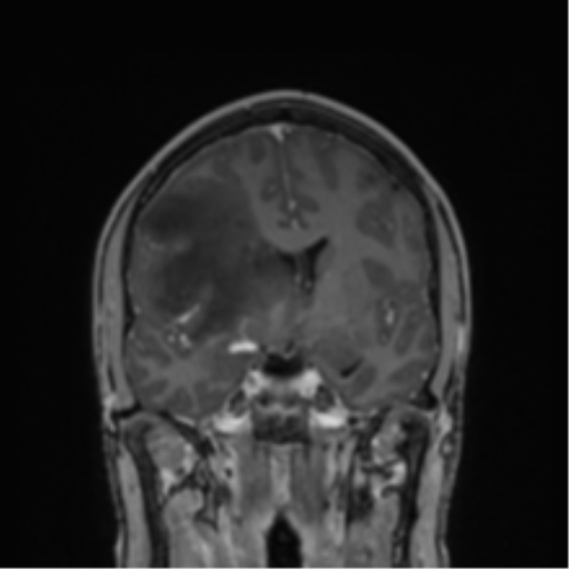 Cerebral abscess (Radiopaedia 60342-68009 H 29).png