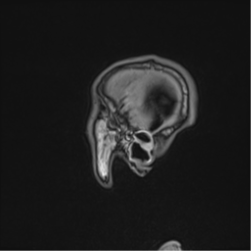 Cerebral abscess (Radiopaedia 60342-68009 Sagittal T1 52).png