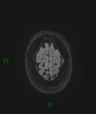 Cerebral abscess and subdural empyema (Radiopaedia 84436-99779 Axial FLAIR 14).jpg