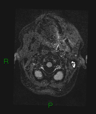 Cerebral abscess and subdural empyema (Radiopaedia 84436-99779 Axial FLAIR 80).jpg