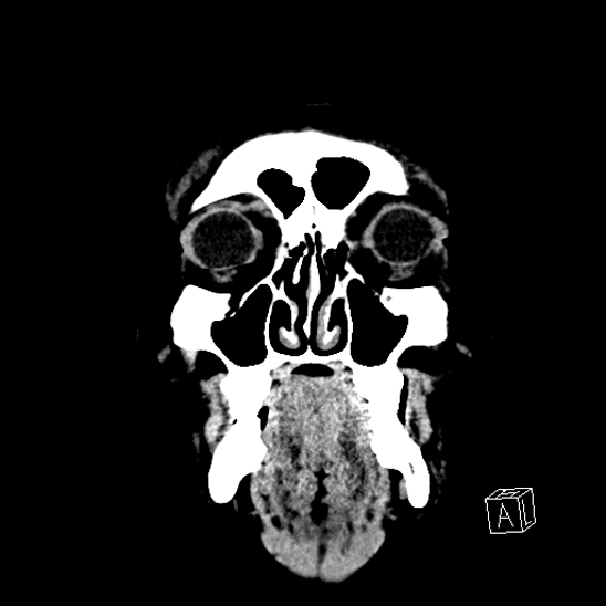 File:Cerebral abscess with ventriculitis (Radiopaedia 78965-91876 B 5).jpg