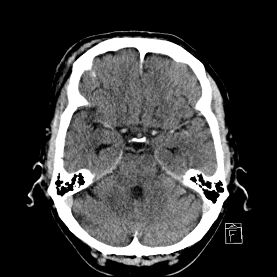 File:Cerebral abscess with ventriculitis (Radiopaedia 78965-91877 A 16).jpg