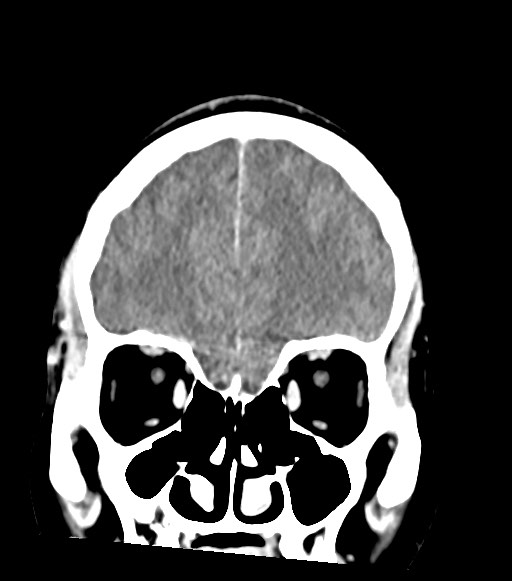 Cerebral abscesses (Radiopaedia 70458-80568 Coronal Contrast 17).jpg