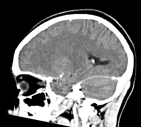 Cerebral abscesses (Radiopaedia 70458-80568 Sagittal Contrast 37).jpg