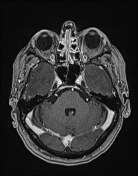 Cerebral amyloid angiopathy-related inflammation (Radiopaedia 58270-65377 Axial T1 C+ fat sat 34).jpg