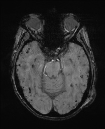 File:Cerebral amyloid angiopathy-related inflammation (Radiopaedia 74836-85849 Axial SWI 26).jpg