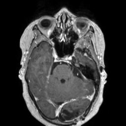 File:Cerebral amyloid angiopathy (Radiopaedia 29129-29518 Axial T1 C+ 49).jpg