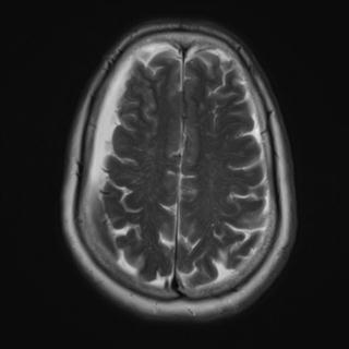 File:Cerebral amyloid angiopathy (Radiopaedia 29129-29518 Axial T2 16).jpg