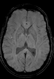 File:Cerebral arteriovenous malformation (Radiopaedia 55798-62372 Axial SWI 21).png