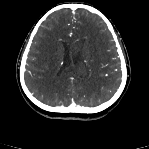 Cerebral arteriovenous malformation (Radiopaedia 73830-84645 Axial C+ delayed 34).jpg