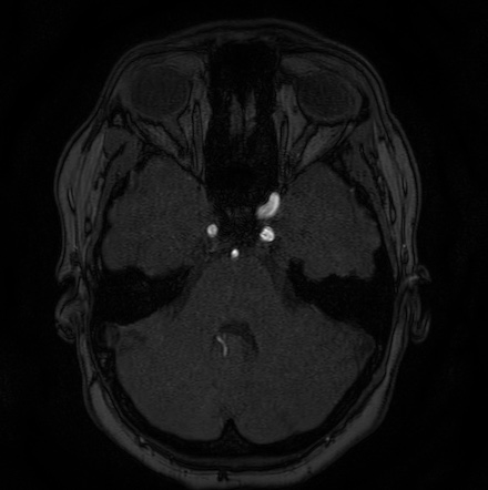 Cerebral arteriovenous malformation (Radiopaedia 74411-85654 Axial MRA 27).jpg