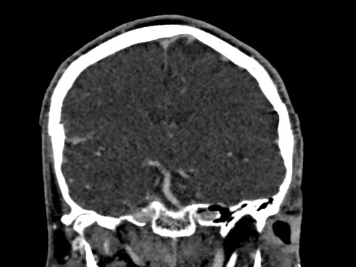Cerebral arteriovenous malformation (Radiopaedia 78188-90746 Coronal C+ delayed 57).jpg