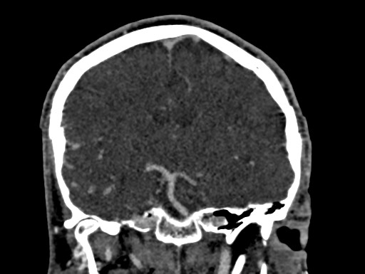 Cerebral arteriovenous malformation (Radiopaedia 78188-90746 Coronal C+ delayed 58).jpg