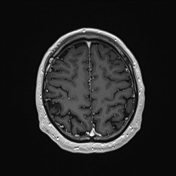 Cerebral arteriovenous malformation (Radiopaedia 84015-99245 Axial T1 C+ 124).jpg
