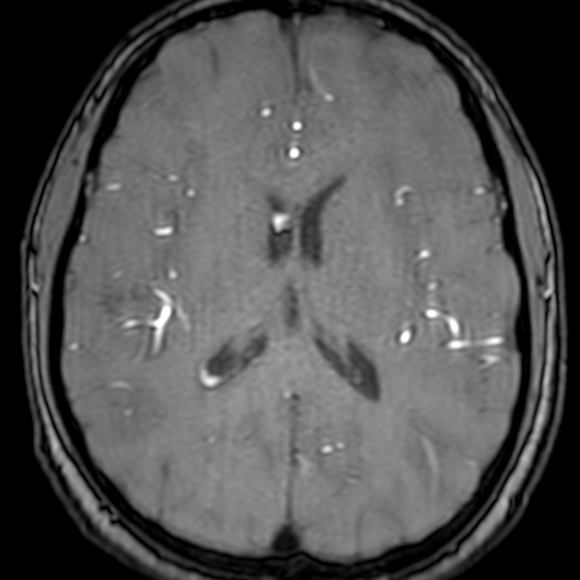 Cerebral arteriovenous malformation at posterior body of corpus callosum (Radiopaedia 74111-84925 Axial MRA 128).jpg